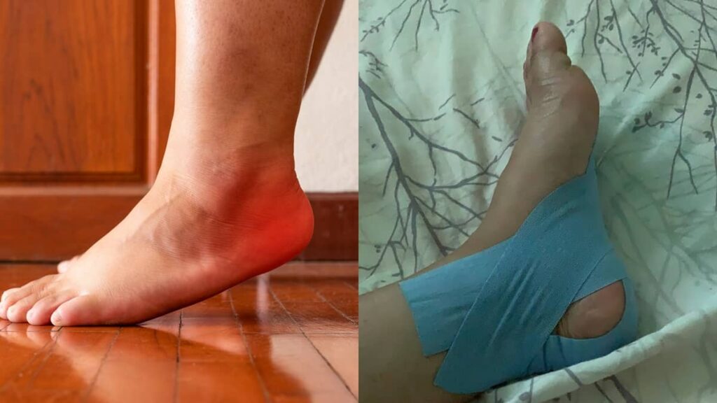 Pernah Kena Plantar Fasciitis? Sakit Tumit Yang Tuhan Je Tahu Rasanya